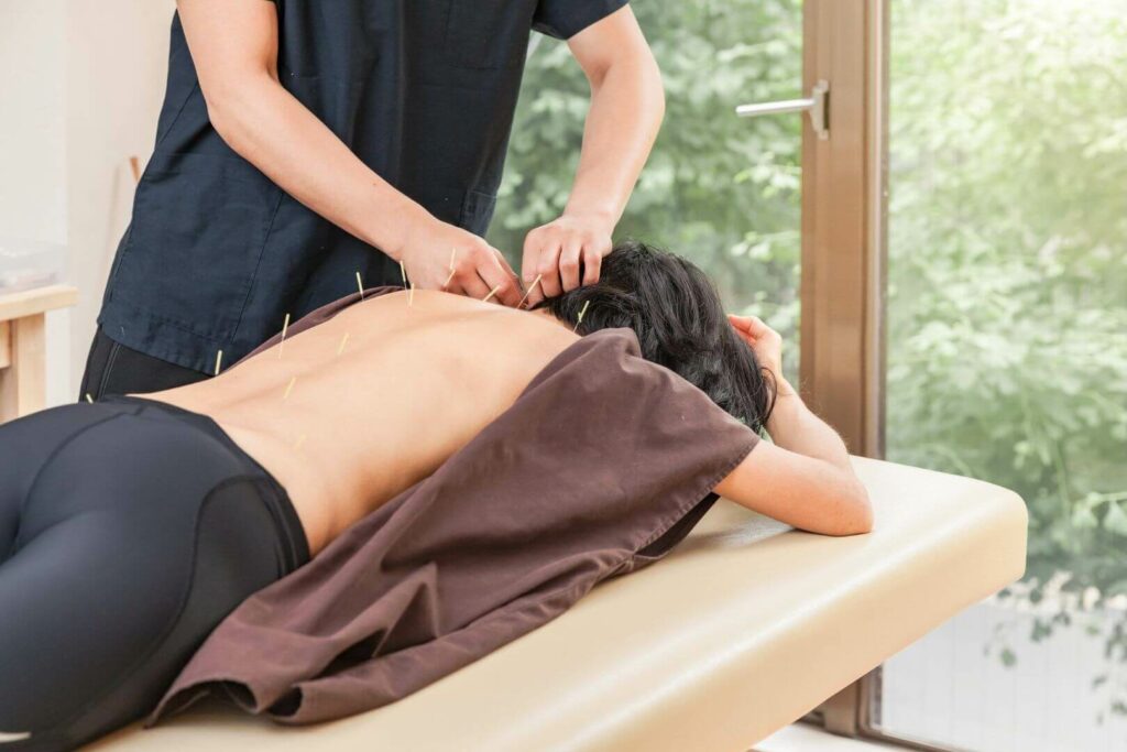 An Acupuncturist putting needles into a persons back.